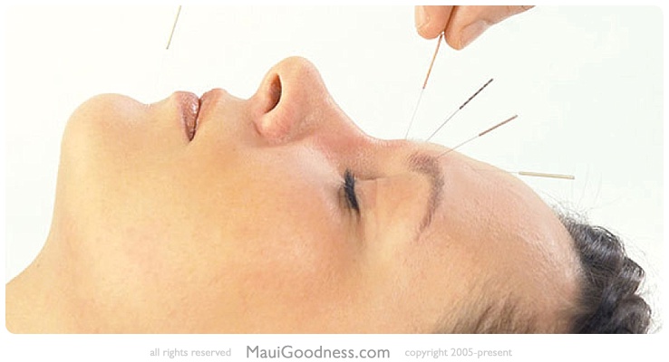 maui micro acupuncture